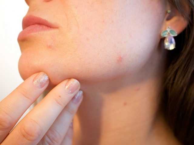 The Best Natural Remedies For Acne